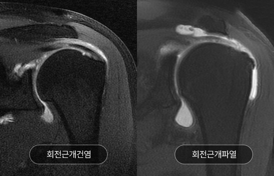 회전근개건염 회전근개파열