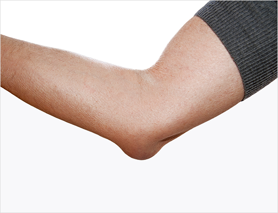 주두 점액낭염 (Student’s Elbow) 