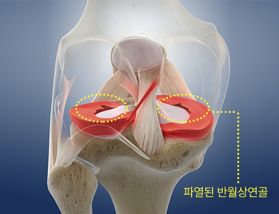 반월상연골 손상