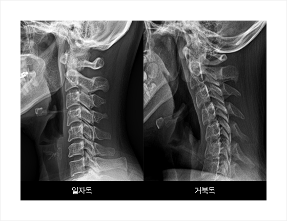 거북목(일자목) 증후군